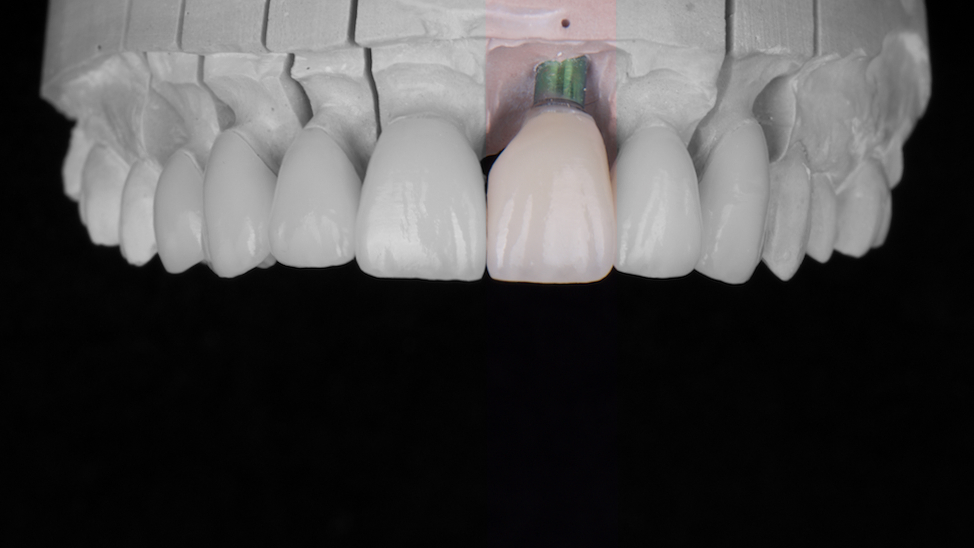 Tratamiento de implantes dentales en LS Dental Costa Rica